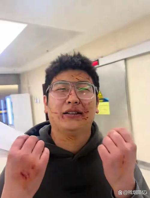 字母哥谈眼部淤青:逛超市遇到个男的抢劫 制服他的过程中被打到